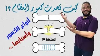 كسر العظام | كيف يحدث، و ماهي أنواعه وأسبابه ؟ | الجزء الأول | سلسلة الاصابات ح3