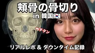 【骨切り】頬骨縮小のダウンタイム3ヶ月ガチレポ【美容整形】