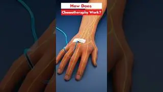 How does chemotherapy work?