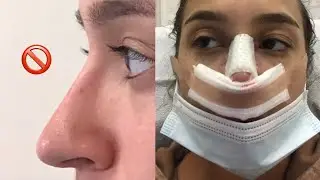 NOSE JOB + FULL RECOVERY PROCESS (Miami)