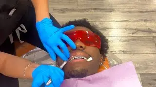 СНИМАЮ БРЕКЕТЫ ЧЕРЕЗ 2 ГОДА!