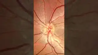 WOW! This is the feeling of facing optic nerve head drusen on fundus autofluorescence.. #retina #o