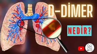 PIHTI TESTİ D-DİMER NEDİR? AKCİĞERE PIHTI ATMASI TAHLİLİ DDİMER NEDİR?