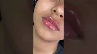 Needless lip filler #shorts