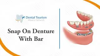 Snap On Denture With Bar Los Cabos - Dental Tourism Mexico