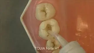 Stamp technique with EQUIA Forte HT