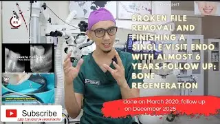 BROKEN FILE REMOVAL, SINGLE VISIT ROOT CANAL TREATMENT, ALMOST 6 YEARS FOLLOW UP & BIG LESION HEALED
