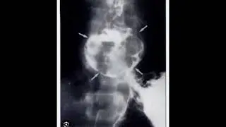 Malignant Esophageal Stricture: Diagnostic approach on Barium Swallow Study