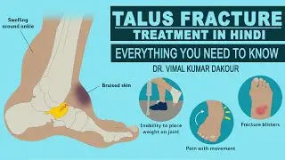 Talus Fracture - Everything You Need To Know - Dr. Vimal Kumar Dakour | Treatment in Hindi