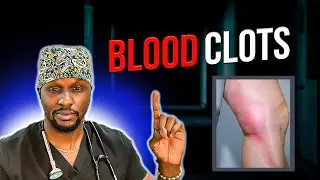 Blood Clot Dangers: Learn the Warning Signs