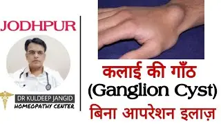 Parmanent treatment of ganglion cyst । हाथ की गांठ का बिना आपरेशन इलाज़ ।