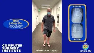 #orthopedics  ✅  Partial Knee Replacement Los Angeles, CA Computer Surgery Institute orthocsi.com