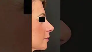 ✨ Stunning Rhinoplasty Transformation ✨