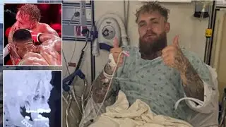 Jake Paul Issues Health Update From Hospital After Jaw Broken by Anthony Joshua | Teeth Removed
