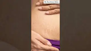 Best Treatments for Stretch Marks Reduction | #stretchmarksreduction  #shorts #youtubeshorts