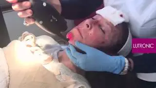 Laser Fraccionado eCO2 - Lutronic - Dra. Bugallo