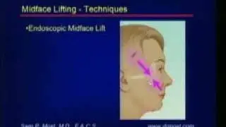 San Francisco Midface Lifting