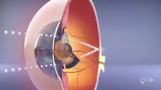 What is Orthokeratology, or Ortho K?