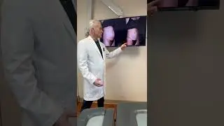 360&deg; Liposuction: See Real Lipo 360 Before & After
