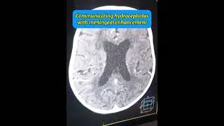 Diagnosing Communicating Hydrocephalus: CT Brain Findings in TB Meningitis vs Pyogenic Meningitis