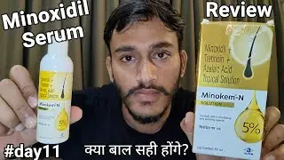 Minoxidil hair regrowth serum review 😱 use करने का सही तरीका! minoxidil Tretinoin solution #11video 