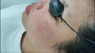 CO2 FRACTIONAL LASER FOR SCAR TREATMENT