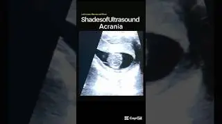 Acrania | ultrasound findings#radiology #ultrasound #bodyscan #medical #viralreels #fypviral