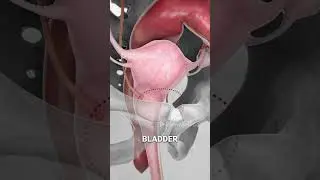 Bladder Removal (3D Animation)