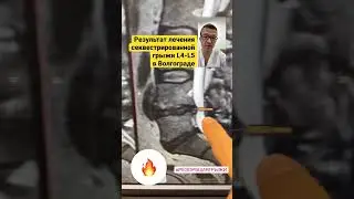 Грыжа L4-L5.