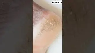 Painful Heel Cracks? Try This Peepal Leaf Home Remedy | Keya Seth Aromatherapy