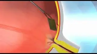 Nano Retina Sight restoration really cool eye tech