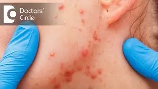 Treatment of Chronic Acne which is not responding to medications - Dr. Sudheendra Udbalker