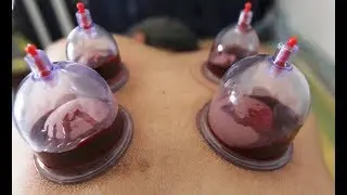Cupping Therapy - Does It Hurt?