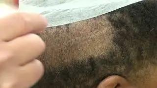 Hair Loss Treatment for Men | [Type of transplant] (# Hair grafts)