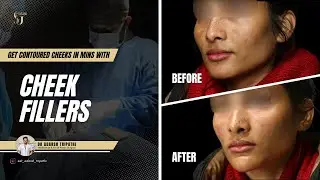 Unlock Your Glow: The Ultimate Cheek Fillers Transformation! | Expert of Cheek filler in Delhi