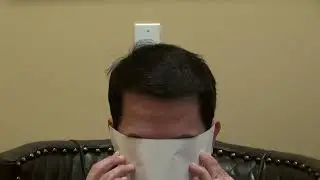 Male Lowering of the Hairline by Dr. John Diep | MHTA CLINIC
