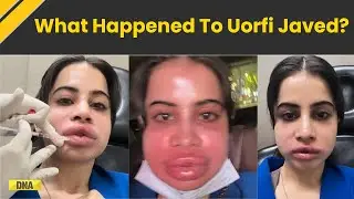 Uorfi Javed Dissolves Lip Fillers After 9 Years, Reveals Swollen Face In Video
