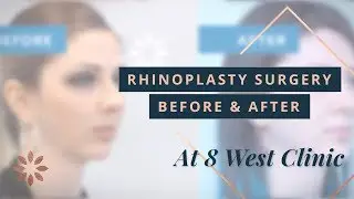 Rhinoplasty Transformations - Before & After Pictures | 8 West Clinic, Dr. Buonassisi in Vancouver