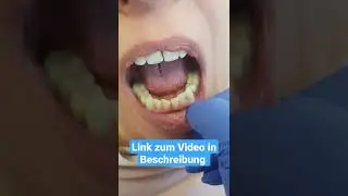 Patientenfall mit neuen festen Z&auml;hnen, wei&szlig;en Kronen und Br&uuml;cken statt Prothese