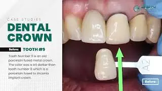[Zen Dental] Case Study: Dental Crown 1 | Dentist in Seattle, Washington 98102