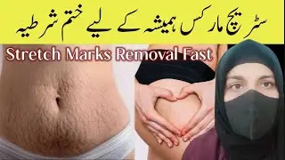 How to Fade Stretch Marks Fast Naturally | 100% Working Home Remedies for Pregnancy & Weight Changes