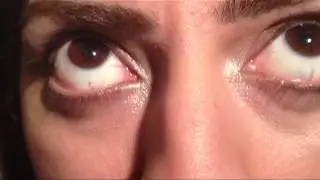 Downbeat Nystagmus-anti-GAD cerebellar syndrome.f4v