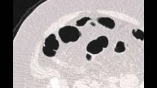 Virtual colon: Large 1.2 cm polyp ascending colon