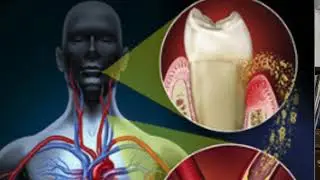 Bacteria in our mouth can cause damage to our body.