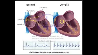 Pathophysiology AVNRT