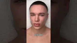 Microneedling before and after