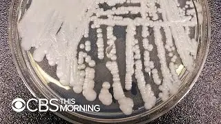 CDC warns about drug-resistant superbug fungus Candida auris