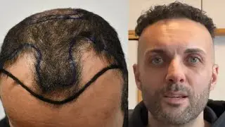 Trasplante capilar antes y después - Recorrido desde el día 1 a los 12 meses