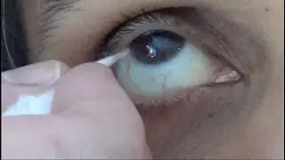 4. CORNEAL SENSATION