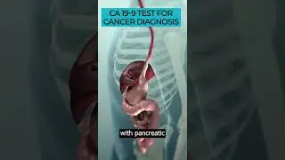 Delve into the CA19-9 test & its role in diagnosing & monitoring certain types of cancer. #CA199Test